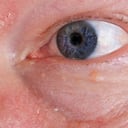 El herpes ocular es una enfermedad vírica que se desarrolla en los ojos.