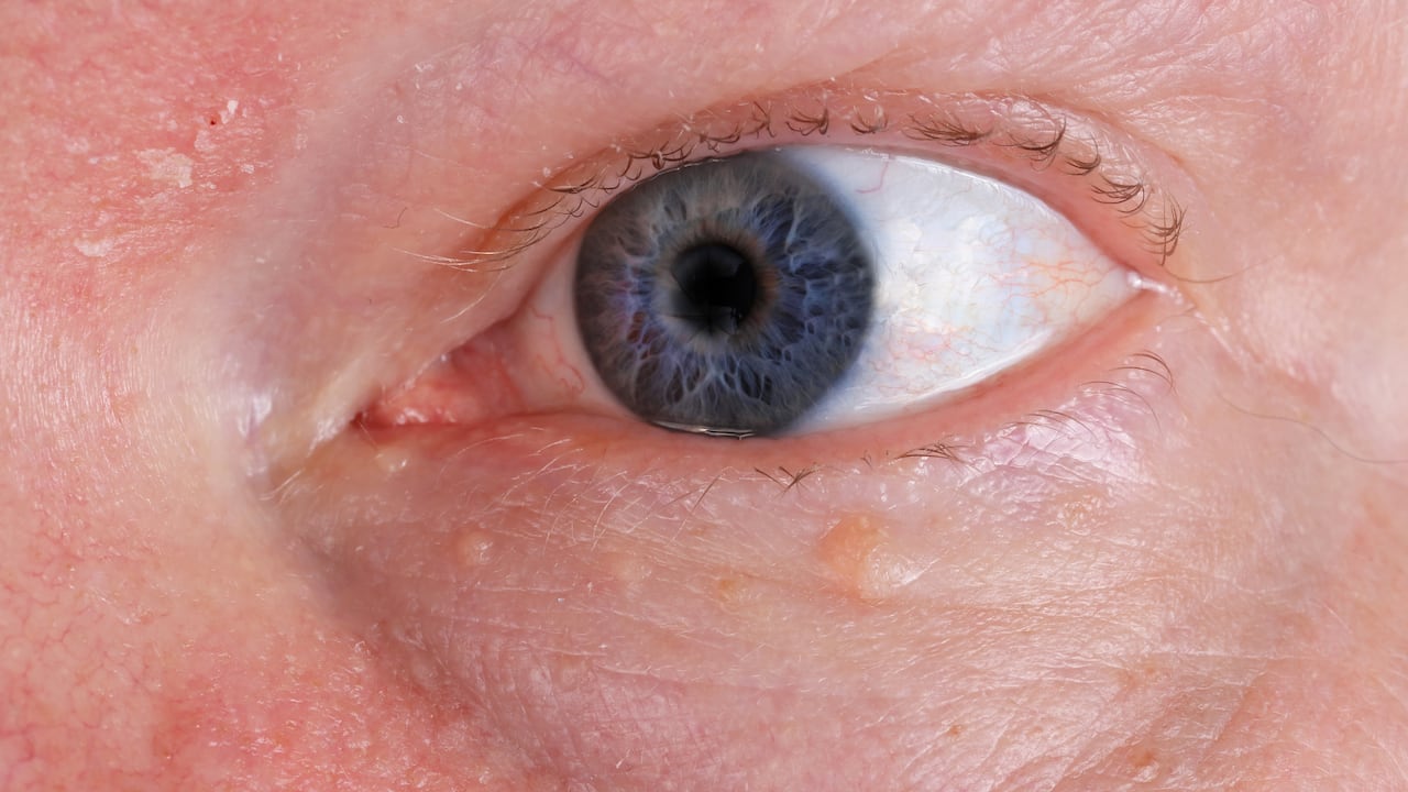 Muchas son las afecciones asociadas con los ojos.