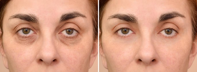 Las ojeras son manchas oscuras que se generan en la parte inferior de los ojos, las cuales aparecen a los lados de la nariz.