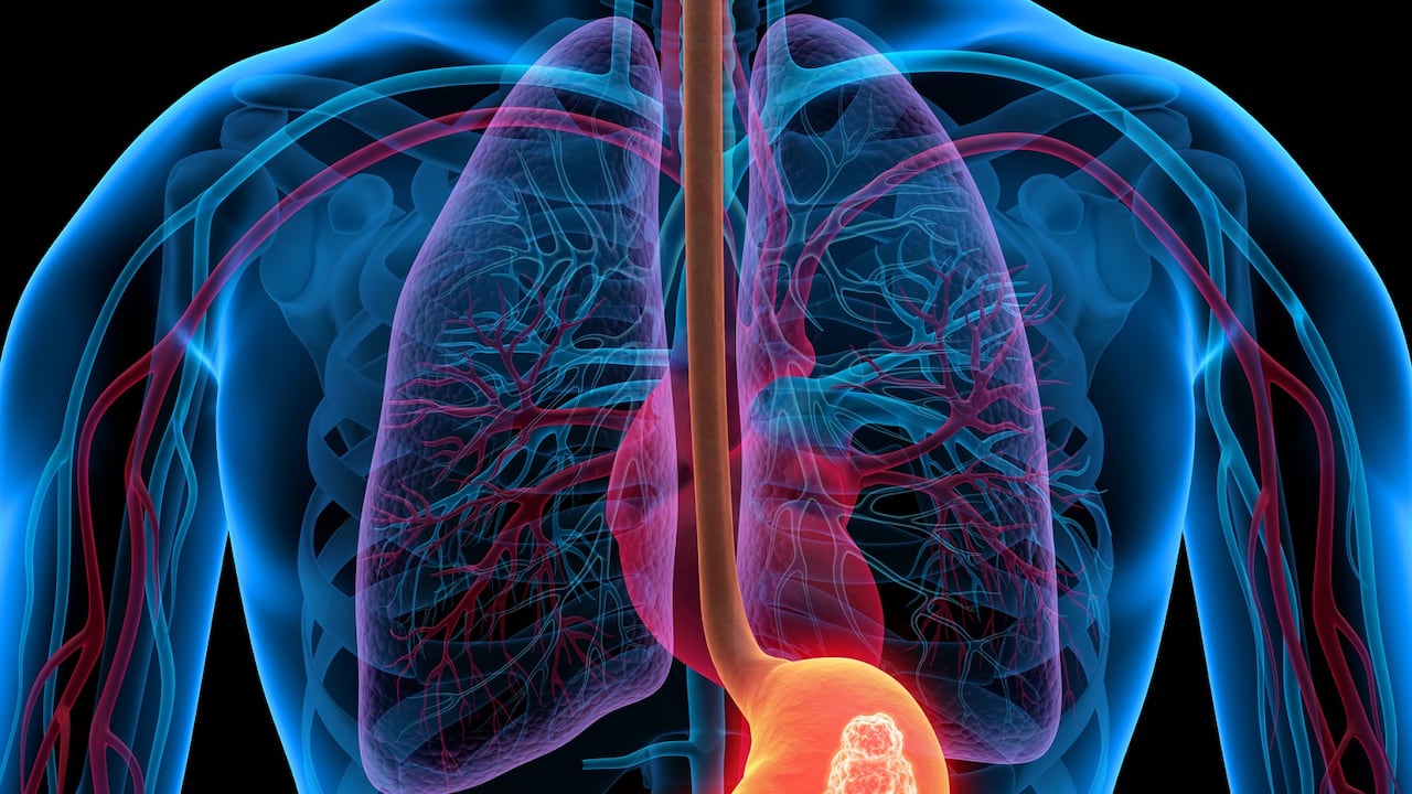 Tumor en el estómago