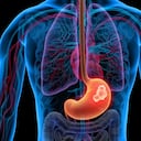 El cáncer de estómago en etapa temprana no genera síntomas.