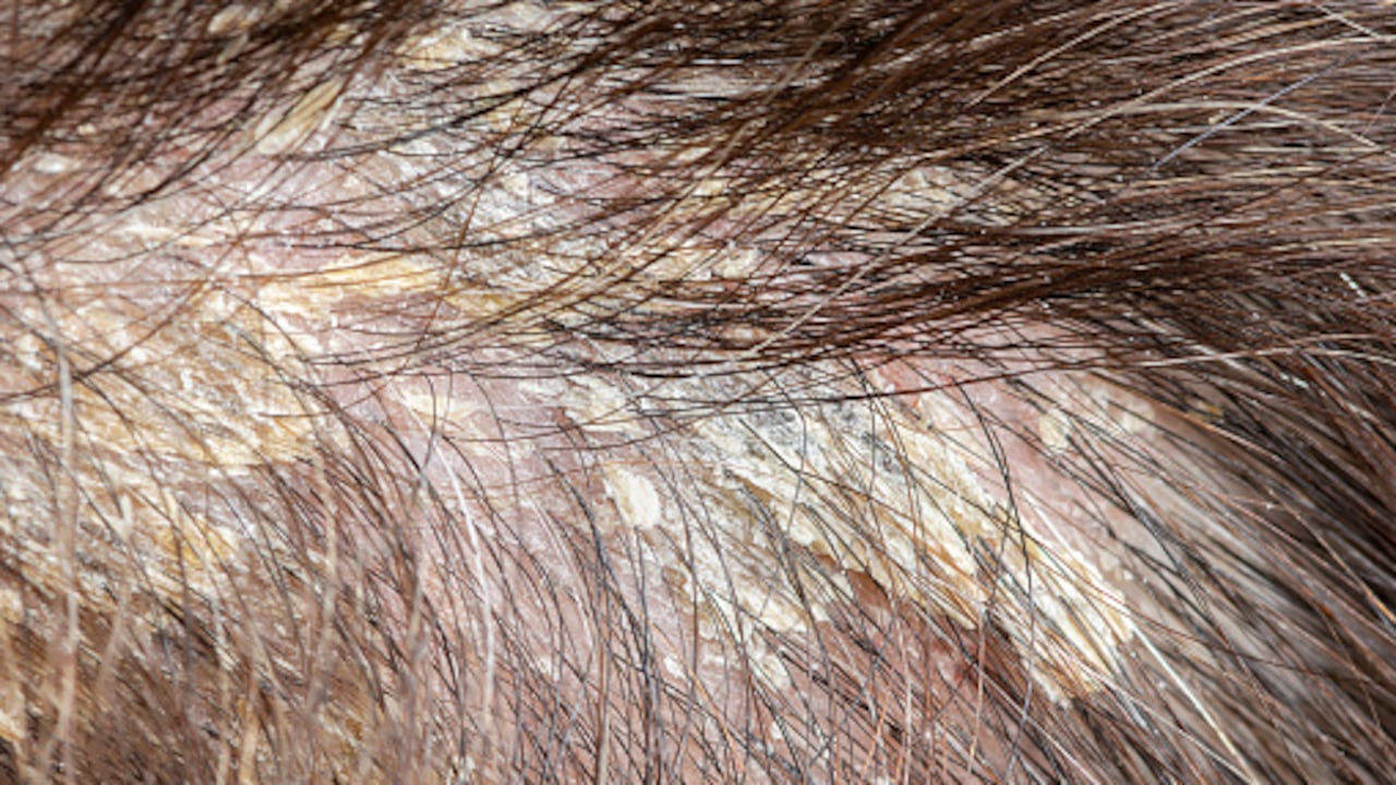 La dermatitis seborrea es una de las causas más comunes de los bultos en la cabeza.