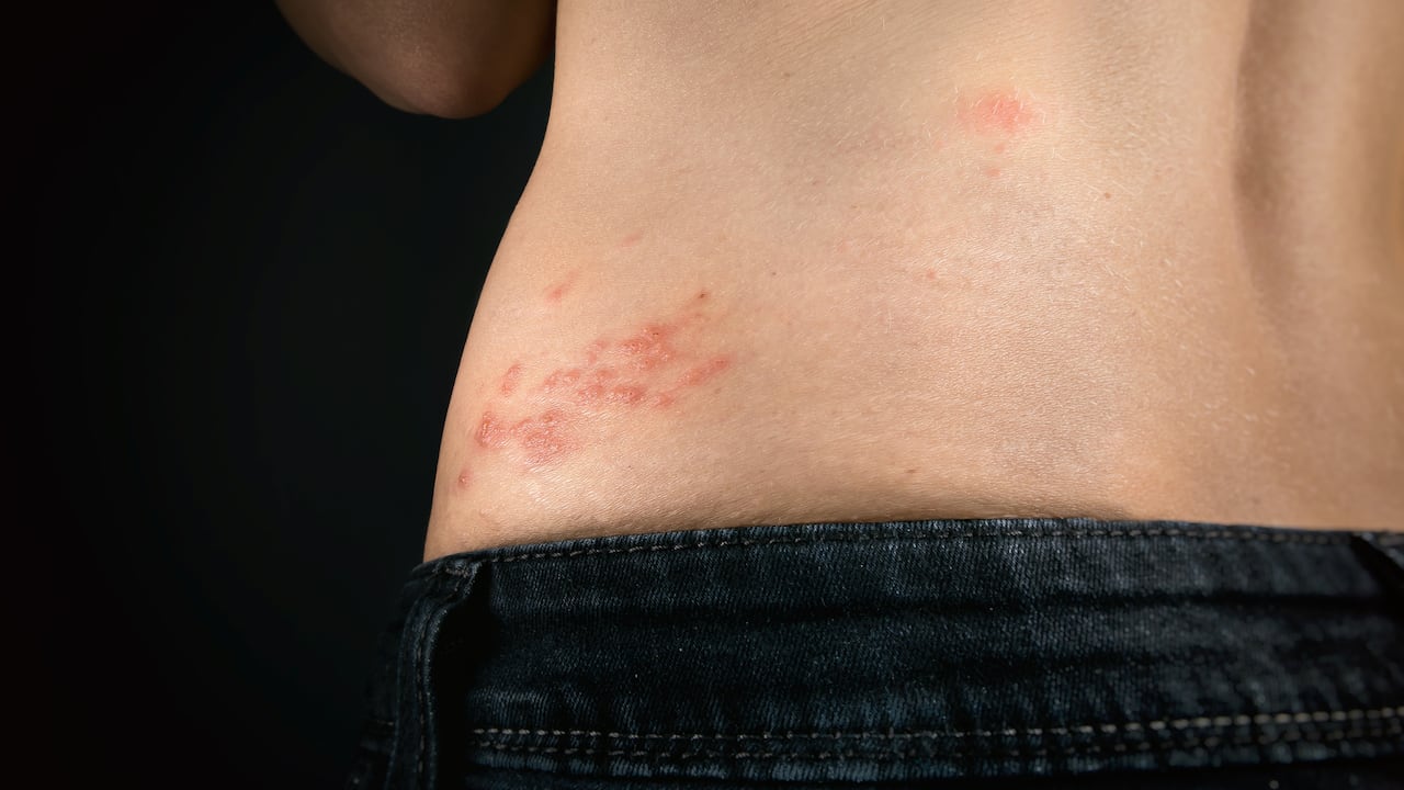 La Organización Mundial de la Salud (OMS) anunció que el brote de viruela del mono que se ha registrado en 16 países, entre ellos España, “todavía puede controlarse” porque el riesgo general de transmisión es “bajo”.