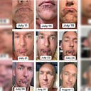 Viruela del mono: las secuelas de salud para Silver Steele, actor porno gay que contrajo la enfermedad.