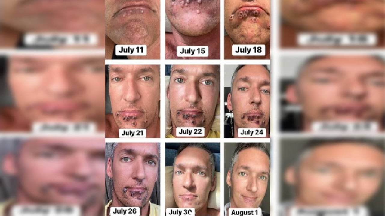 Viruela del mono: las secuelas de salud para Silver Steele, actor porno gay que contrajo la enfermedad.
