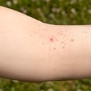 Las verrugas pueden ser contagiosas.