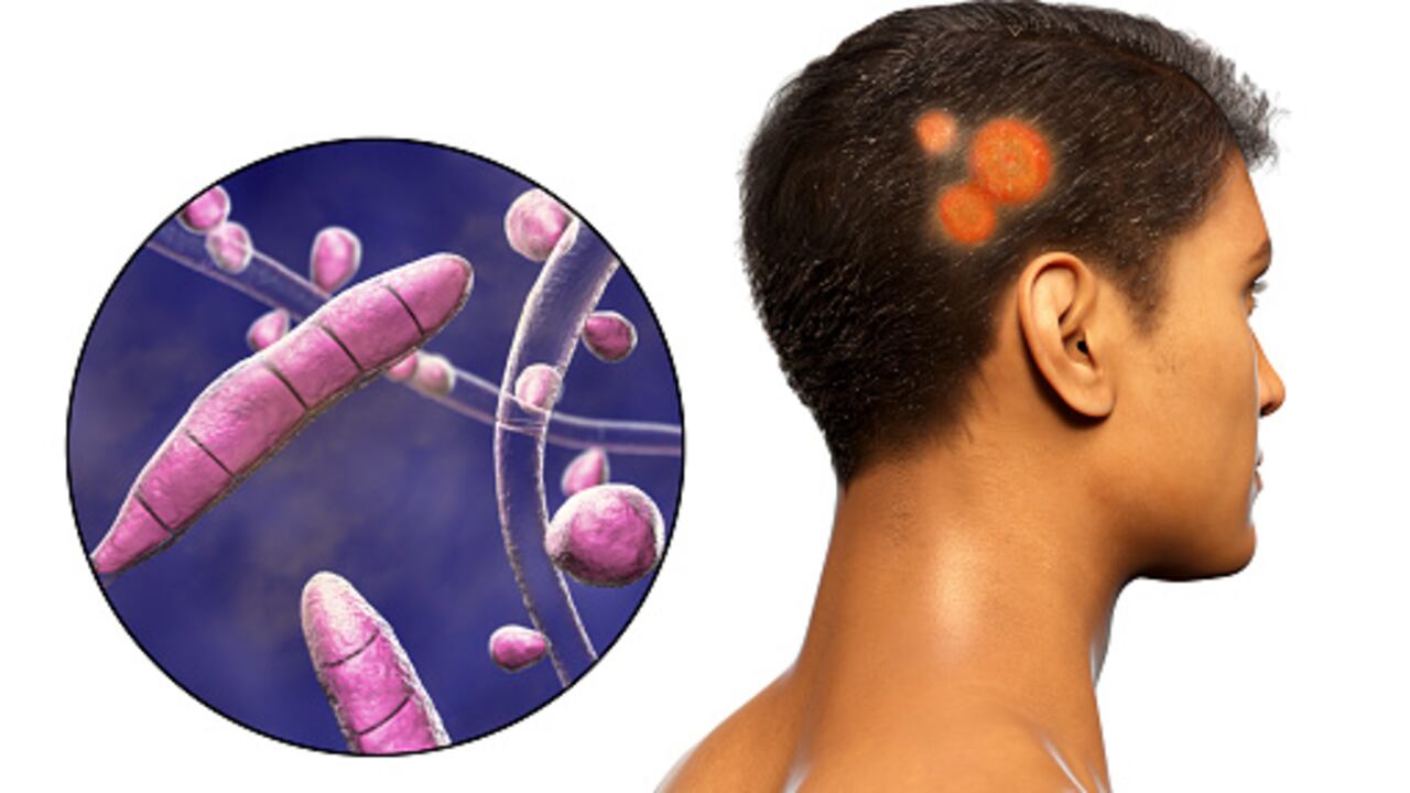 El vinagre de manzana elimina los hongos en la cabeza.