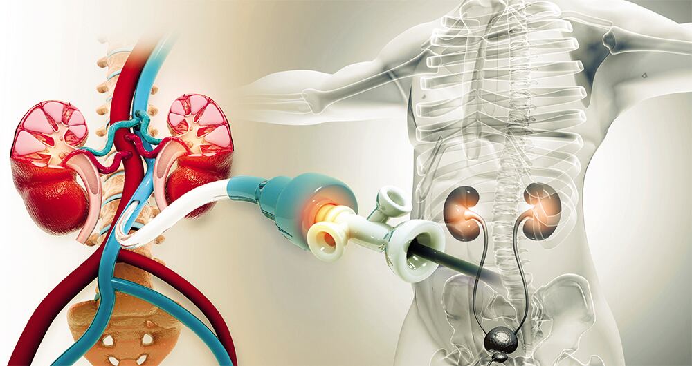 La vida de  los pacientes trasplantados de riñón depende de medicamentos especializados que les garanticen que el órgano que recibieron será tolerado.