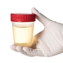 El color de la orina puede revelar si la persona padece alguna enfermedad.