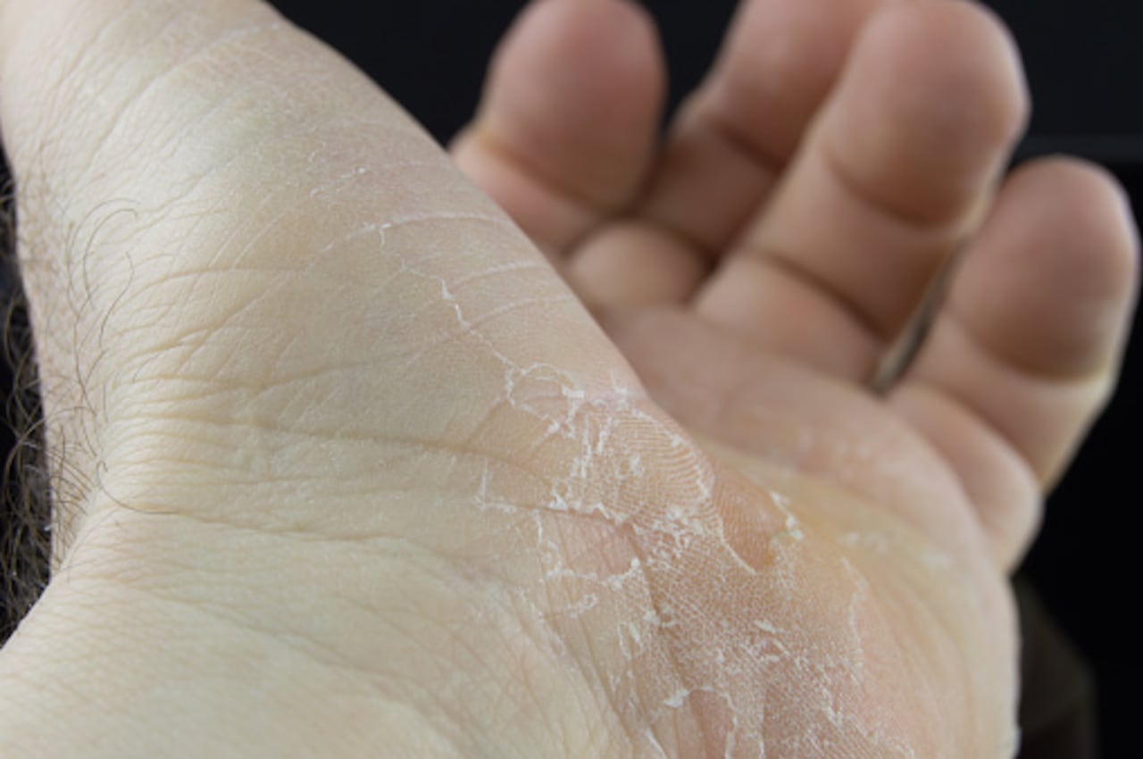 Las grietas en las manos pueden ser por el frío.
