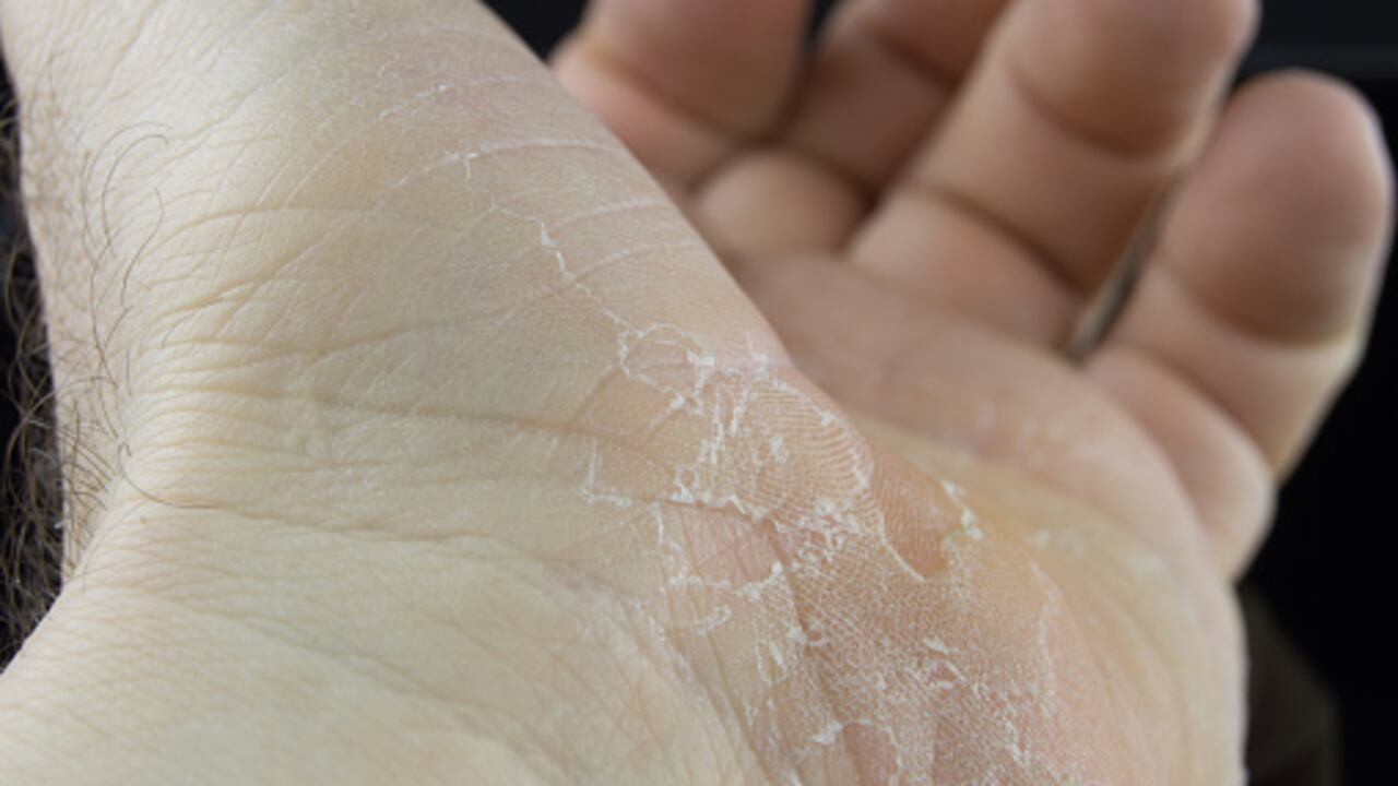 Las grietas en las manos pueden ser por el frío.