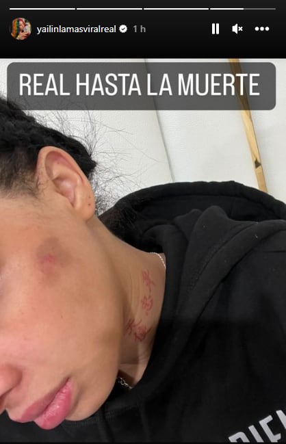 Esta fue la foto que publicó Yailin en la que se observa un golpe que supuestamente le habría propinado Anuel.