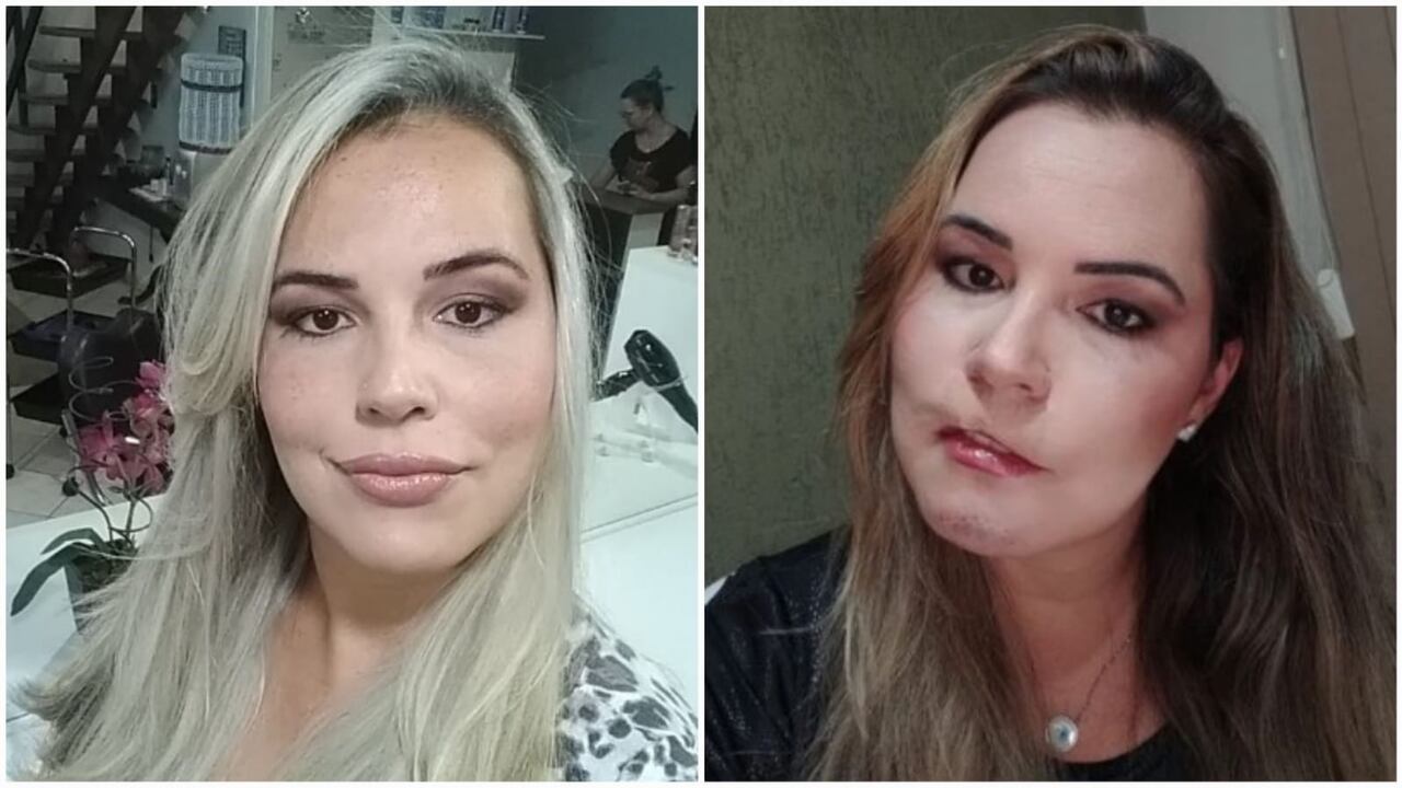 Mujer brasileña libra un proceso legal, tras procedimiento estético. Ahora muestra avances de su recuperación.