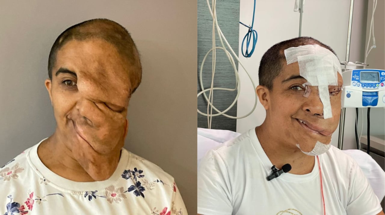 Sandra Milena Castañeda antes y después de ingresar al quirófano.