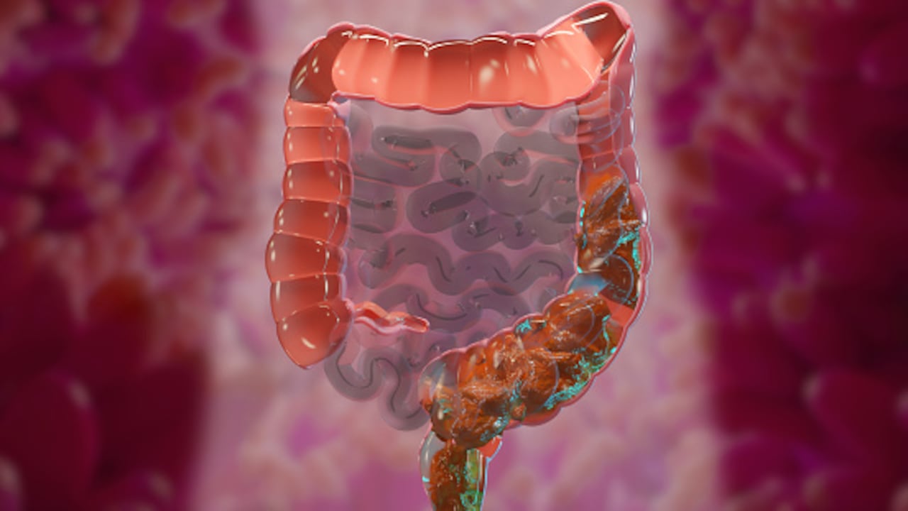 Los riesgos que tiene hacerse un enema de café.