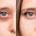 Las ojeras pueden aparecer por no dormir bien.