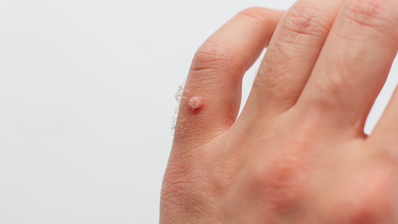 Mezquinos en la piel: ¿Por qué salen y que tratamientos hay?