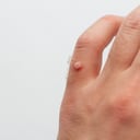 Mezquinos en la piel: ¿Por qué salen y que tratamientos hay?