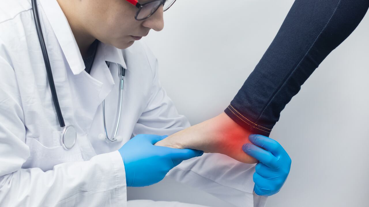 El espolón calcáneo produce un dolor intenso en el talón.