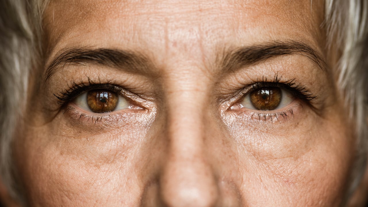 Se trata de una línea de expresión común en las personas que fruncen el ceño.