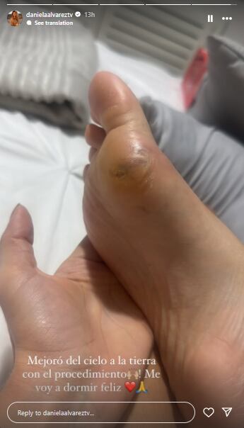 Daniella Álvarez mostró el proceso de recuperación de su pie