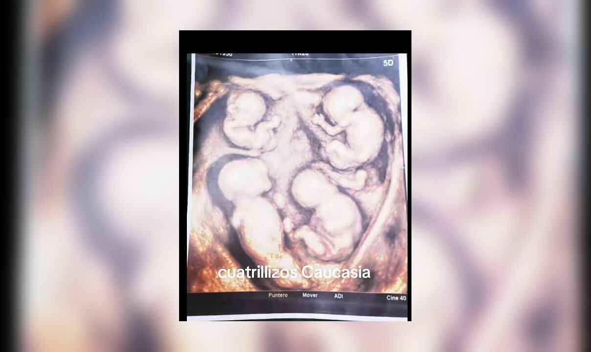 Ecografía de los bebés que esperan la pareja conformada por María Tapia y Jonatan Zapa, en Caucasia, Antioquia.