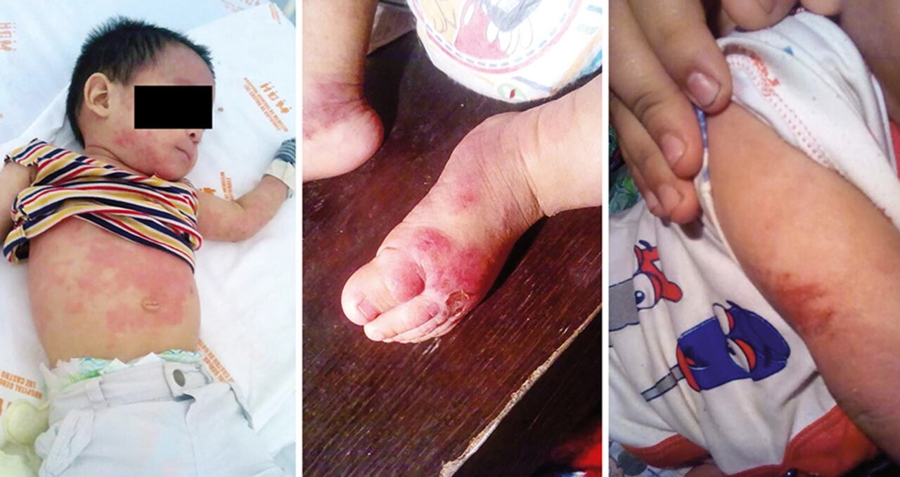 Muchos de los niños nacidos después de 2015 en Patio Bonito presentan este tipo de problemas en la piel. Se cree que estarían relacionados con la calidad del agua.