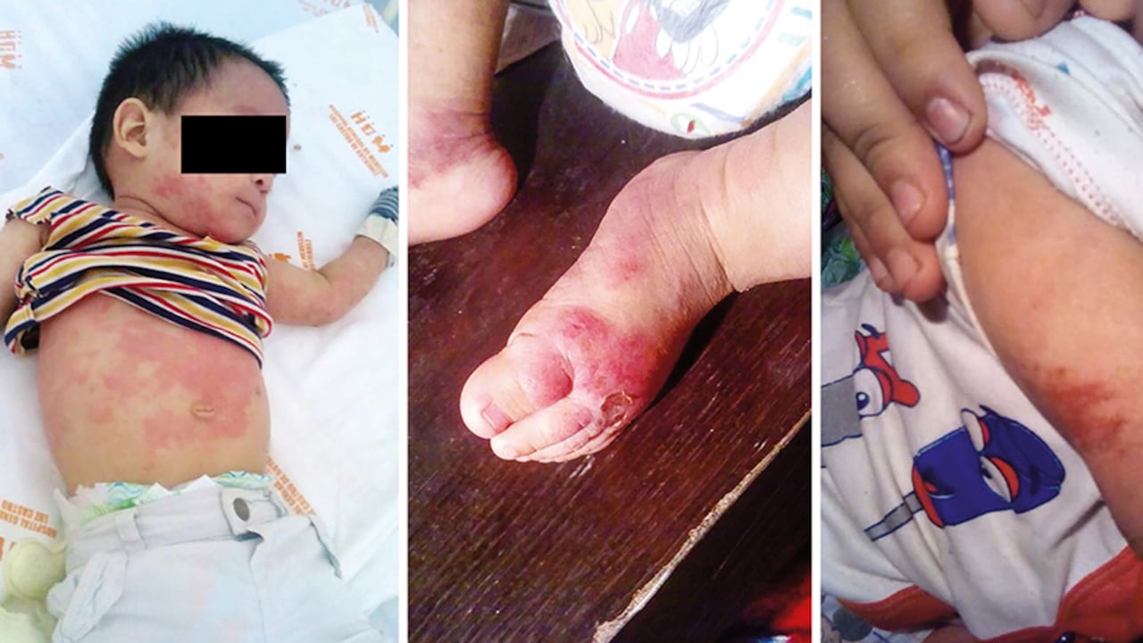 Muchos de los niños nacidos después de 2015 en Patio Bonito presentan este tipo de problemas en la piel. Se cree que estarían relacionados con la calidad del agua.