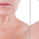 Arrugas en el cuello