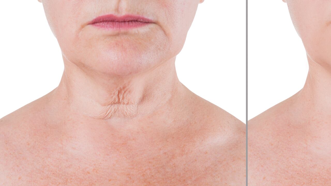 Las arrugas son líneas y pliegues que se forman en la piel y son una parte natural del envejecimiento.