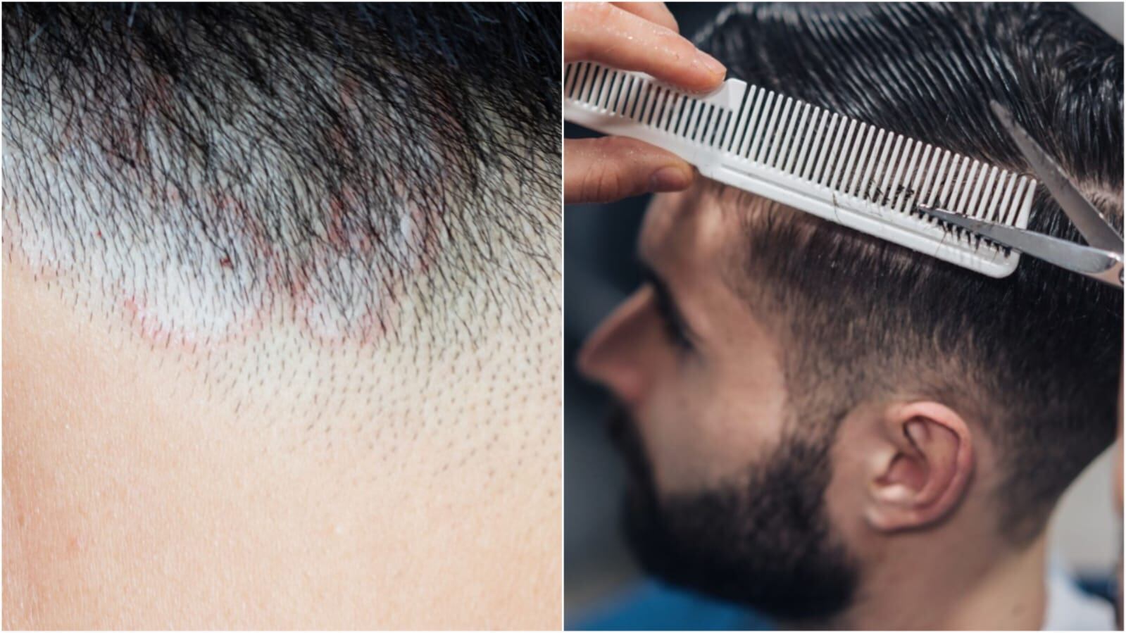 Dermatólogos españoles tienen en la lupa un brote de tiña desde hace dos años.