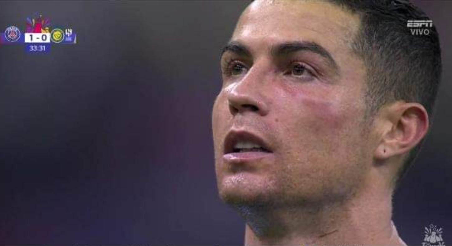 El exjugador del Real Madrid terminó con un moretón en su rostro