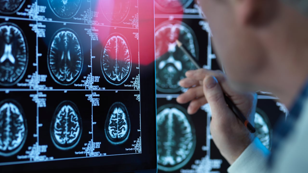 Descubren un nuevo tipo de célula capaz de evitar que las personas sufran de Alzheimer.