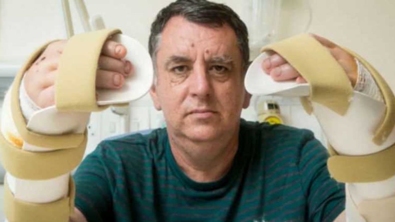 Chris King dijo que se siente "formidable" tras recibir su trasplante de manos.