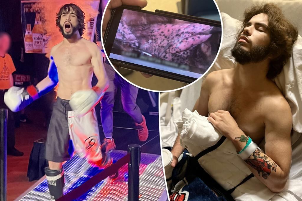 Sean Tobin tuvo un pulmón lleno de manchas de carbón por el uso de vapeadores y cigarrillo electrónico