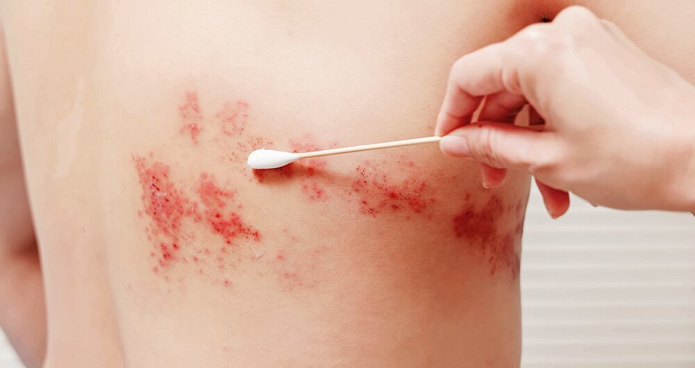 A diferencia de los herpes simples tipo 1 o 2, el herpes zóster produce lesiones en diversas partes del cuerpo. 