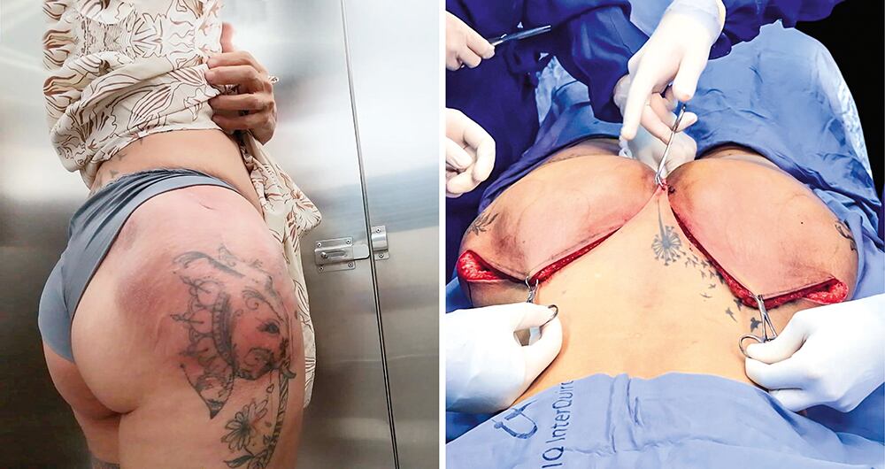     Estos son los estragos que dejan los procedimientos estéticos clandestinos en Medellín. La recuperación cuesta millones. 