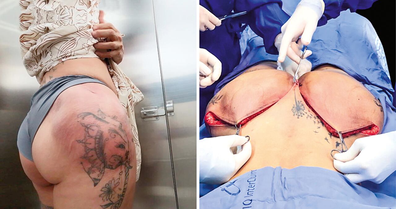 Estos son los estragos que dejan los procedimientos estéticos clandestinos en Medellín. La recuperación cuesta millones.