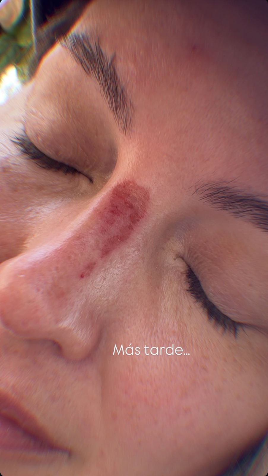 Herida en el rostro de Claudia Bahamón.