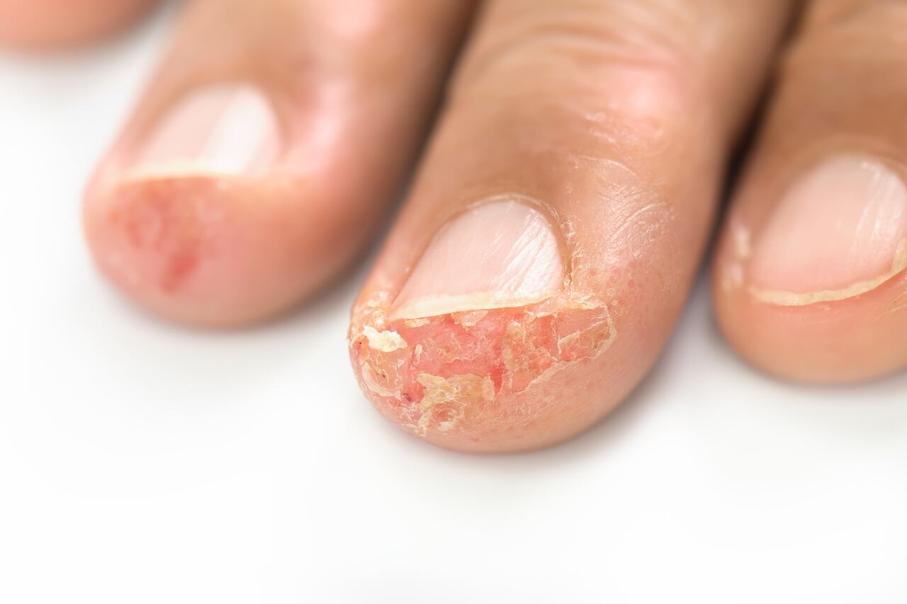 ¿Por qué aparecen ampollas en las manos y en los pies?