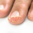 ¿Por qué aparecen ampollas en las manos y en los pies?