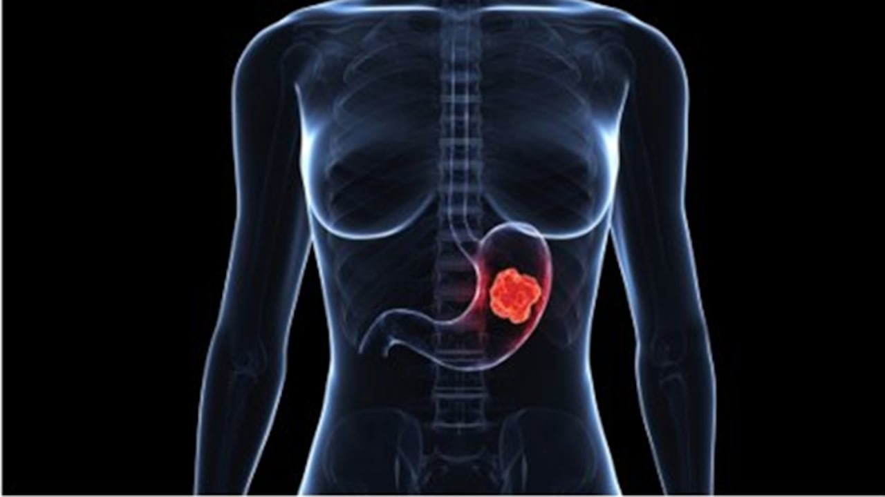 El número de casos de cáncer gástrico ha aumentado en el país.