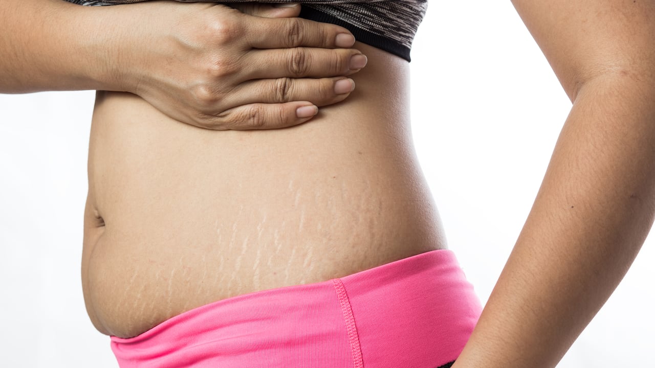 La celulitis, a diferencia de las estrías, se manifiesta en forma de hoyuelos en la piel.