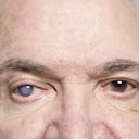 Una persona con una catarata en su ojo.