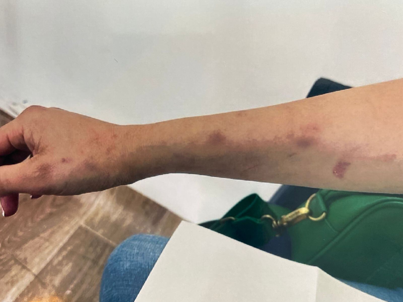 El aterrador relato de una anestesióloga atacada a mordiscos por su expareja sentimental, otro anestesiólogo