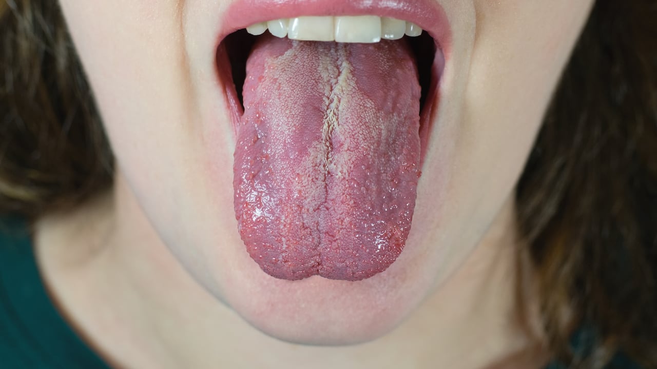 La lengua blanca está asociada con diferentes condiciones.