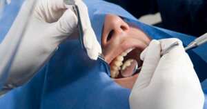 La frecuente exposición al azúcar es clave para el desarrollo de caries.