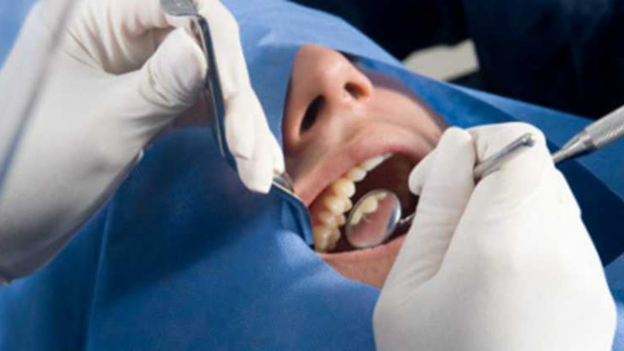 La frecuente exposición al azúcar es clave para el desarrollo de caries.