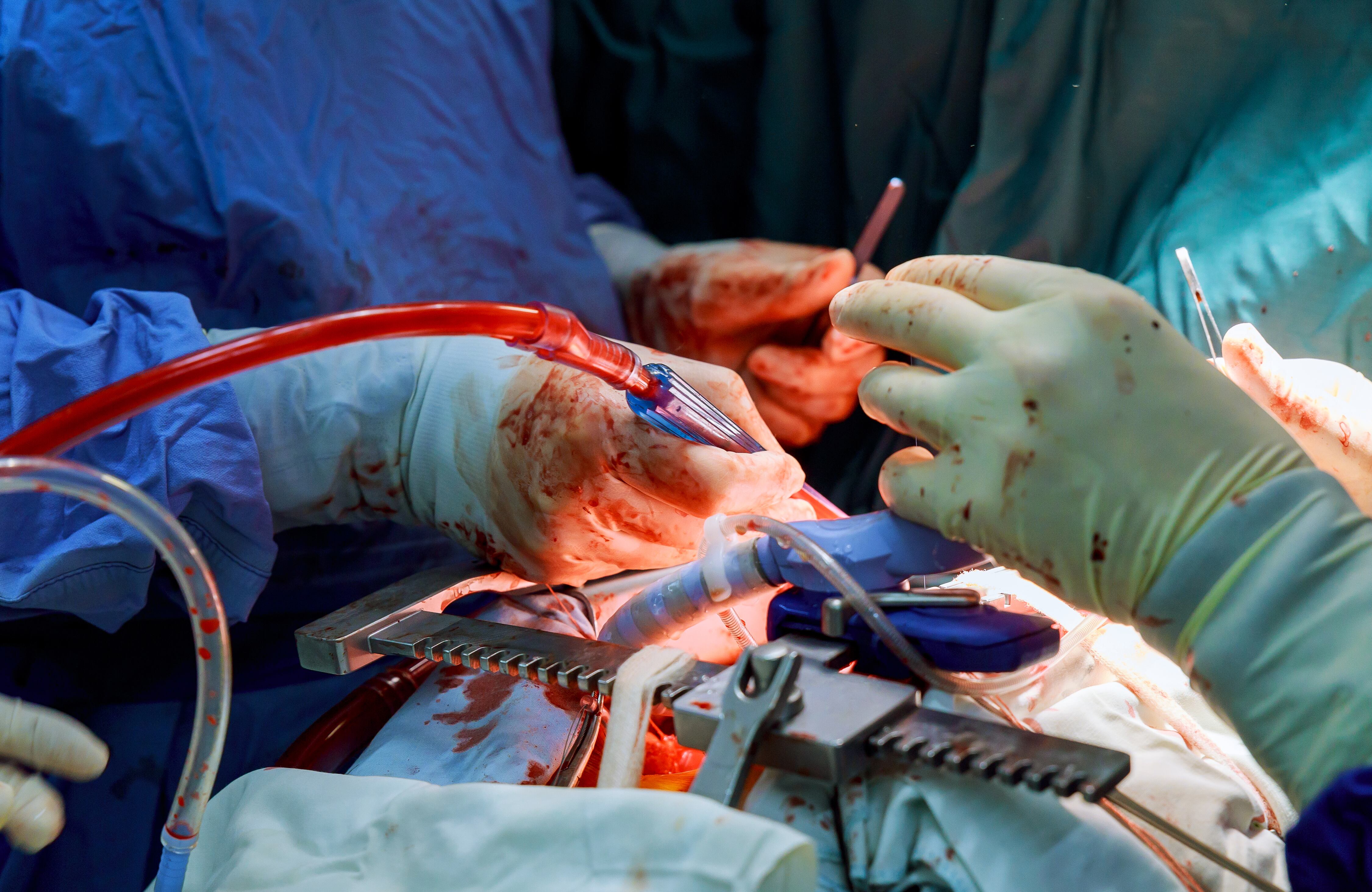 Primer plano de una cirugía mínimamente invasiva a corazón abierto de cordón umbilical.