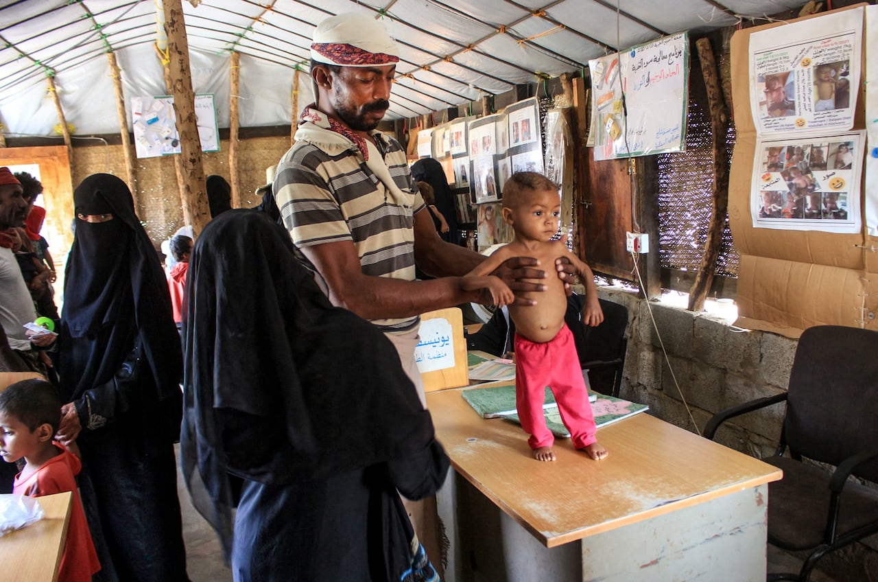 La niña yemení de tres años, Randa Ali, que sufre de desnutrición aguda severa, recibe ayuda de su padre en una clínica en el campamento de Al-Khudash para personas desplazadas en el distrito de Abs de la gobernación de Hajjah, en el noroeste de Yemen, el 19 de febrero de 2022. (Foto de ESSA AHMED / AFP)